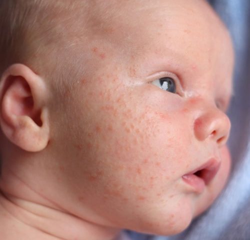 درمان جوش صورت نوزاد و قرمزی پوست صورت نوزاد