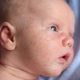 درمان جوش صورت نوزاد و قرمزی پوست صورت نوزاد