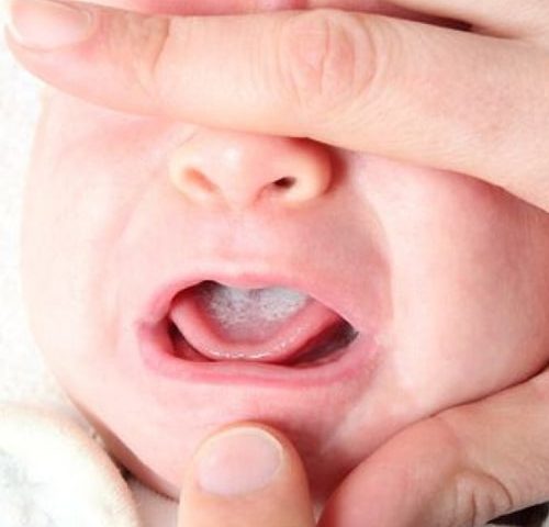 درمان برفک دهان نوزاد و کودک