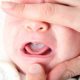 درمان برفک دهان نوزاد و کودک